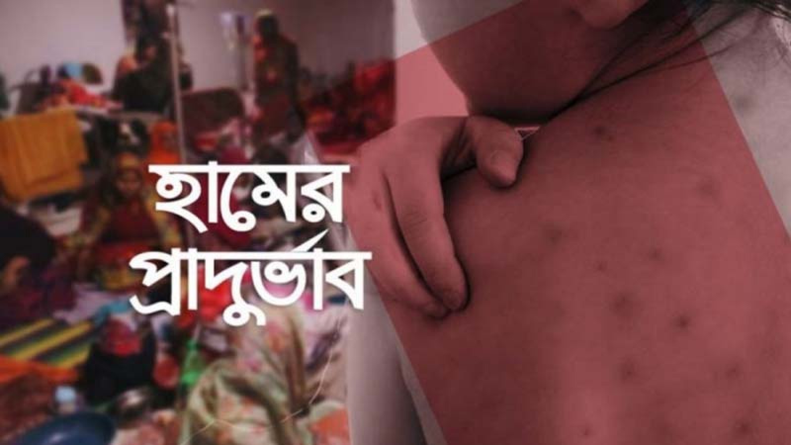 হামের উপসর্গে ফের প্রাণহানি, মোট মৃত্যু ৬৩১