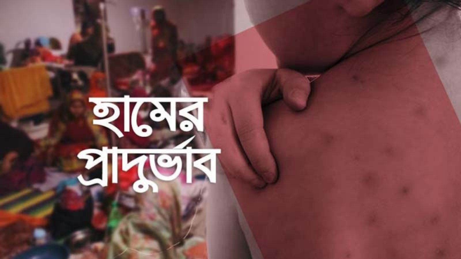 হাম উপসর্গে একদিনে আরও ৭ মৃত্যু