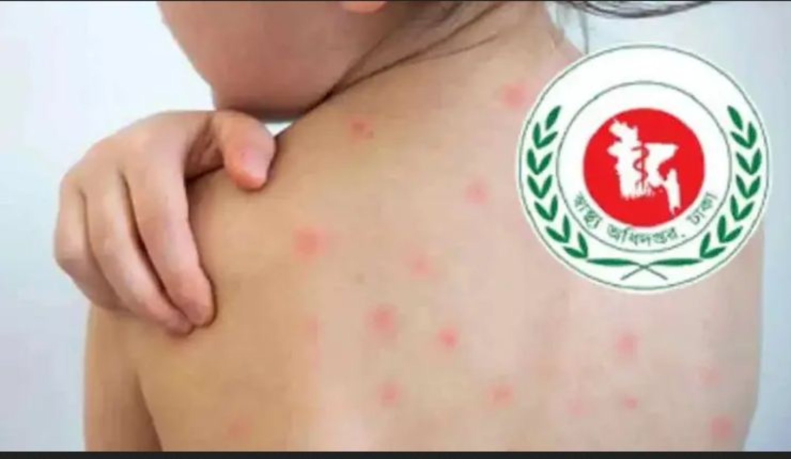 হামের উপসর্গে আরও ৭ মৃত্যু
