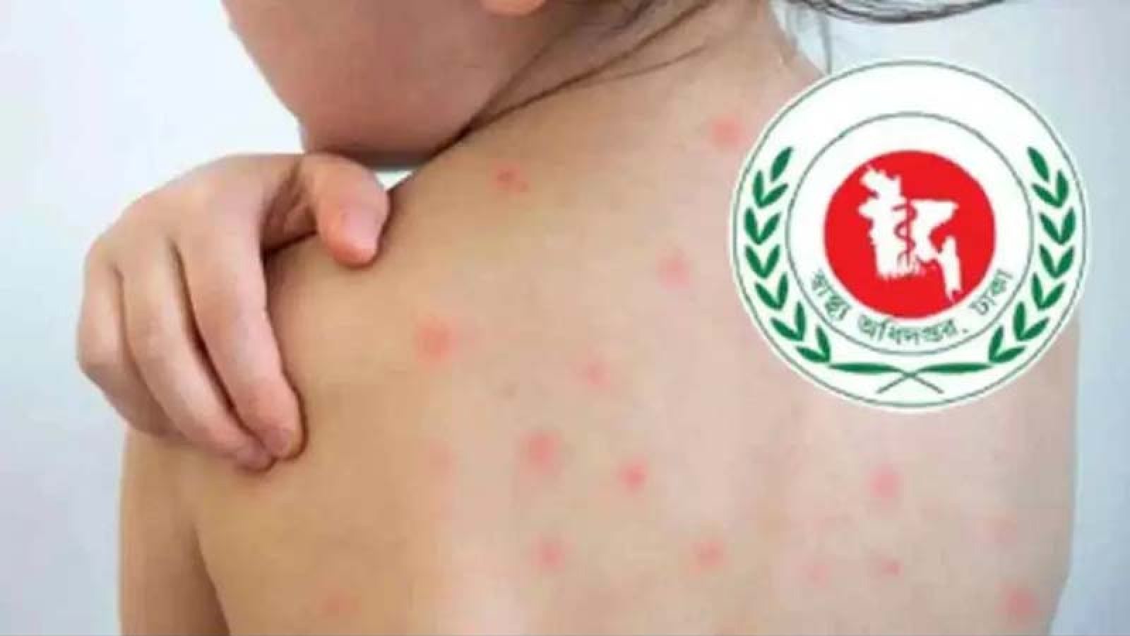 হাম উপসর্গে আরও ৬ শিশুর মৃত্যু