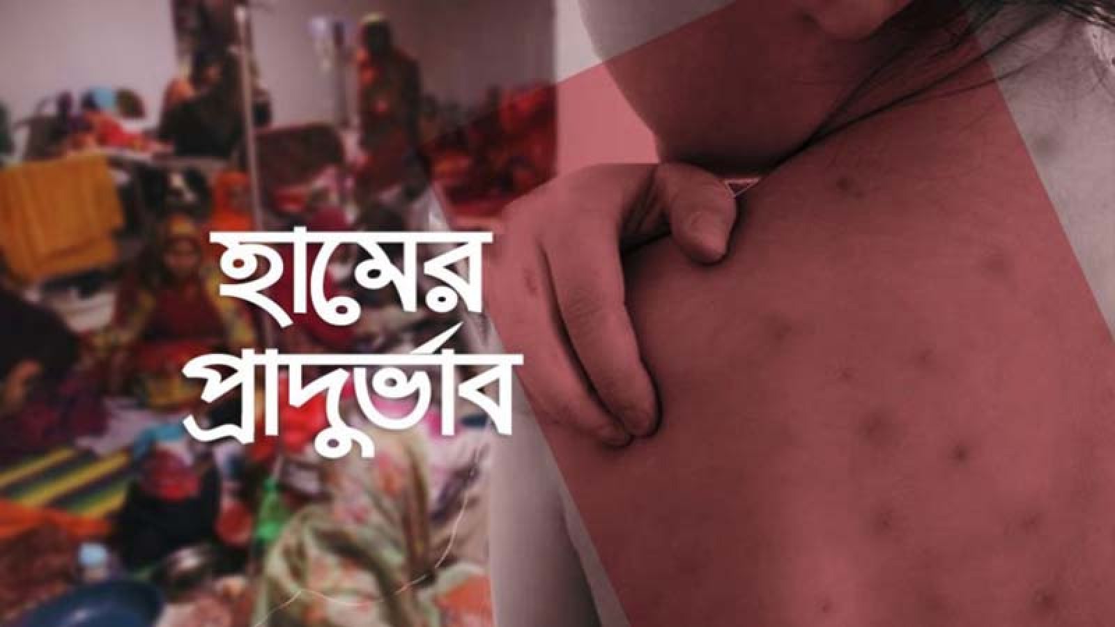 হামের উপসর্গে শিশুমৃত্যু ৬০০ ছুঁইছুঁই