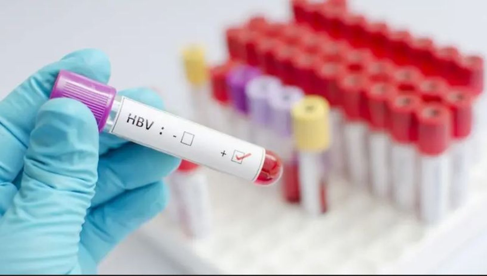 এক বছরে বিশ্বজুড়ে হেপাটাইটিস বি কমেছে ৩২ শতাংশ