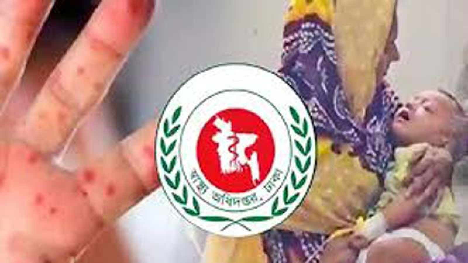 হাম ও উপসর্গে আরও ১২ মৃত্যু
