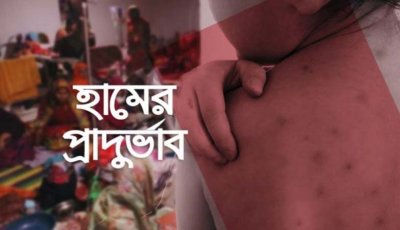 হামের উপসর্গে ফের প্রাণহানি, মোট মৃত্যু ৬৩১